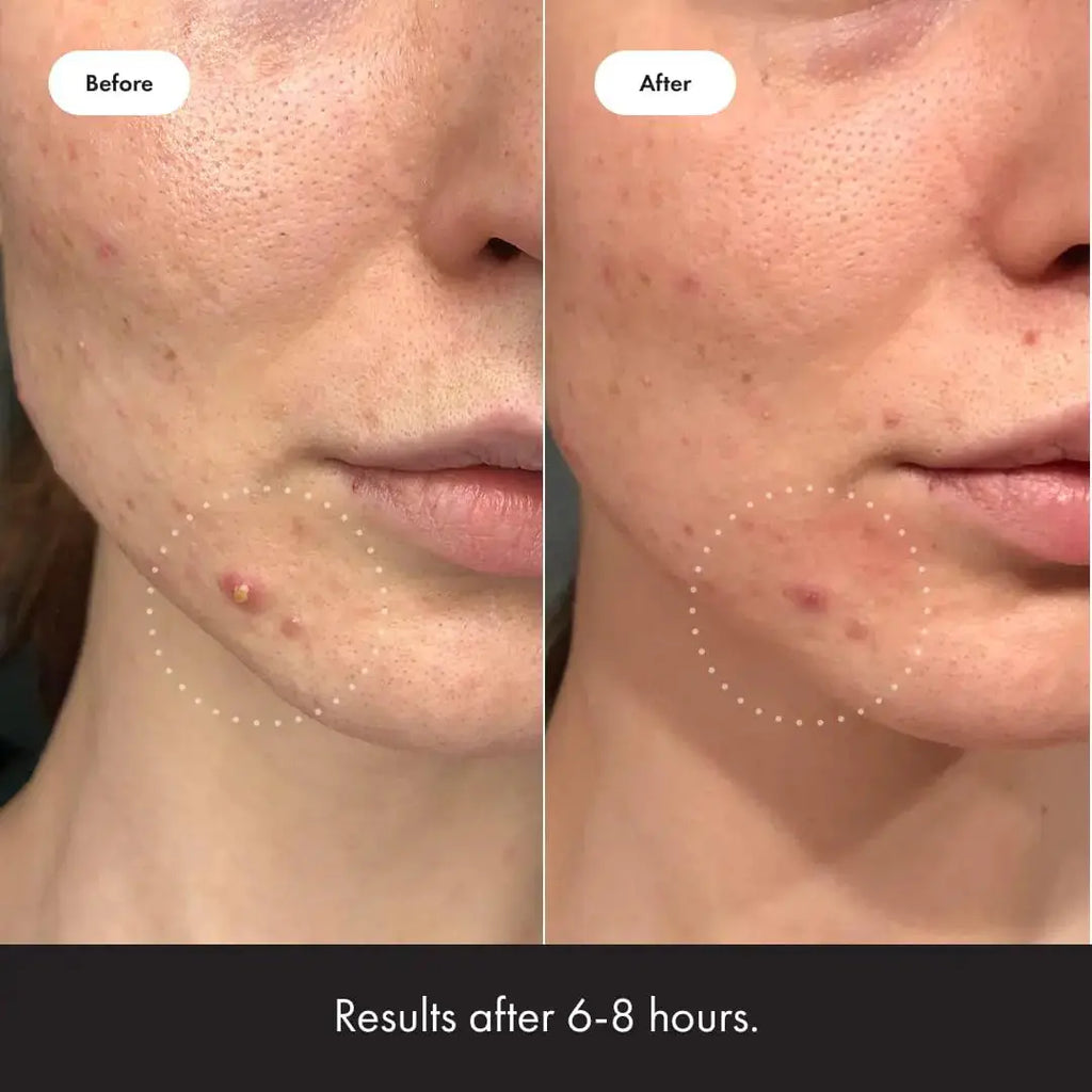 Hero Cosmetics Mighty Patch™ Invisible+ Patch - Daytime Hydrocolloid Acne Pimple Patches