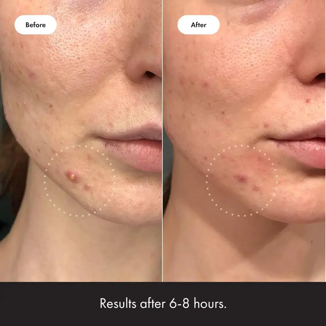 Hero Cosmetics Mighty Patch™ Invisible+ Patch - Daytime Hydrocolloid Acne Pimple Patches