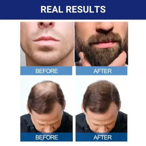 KIRKLAND Signature Minoxidil for Men - 5% Extra Strength Hair Regrowth