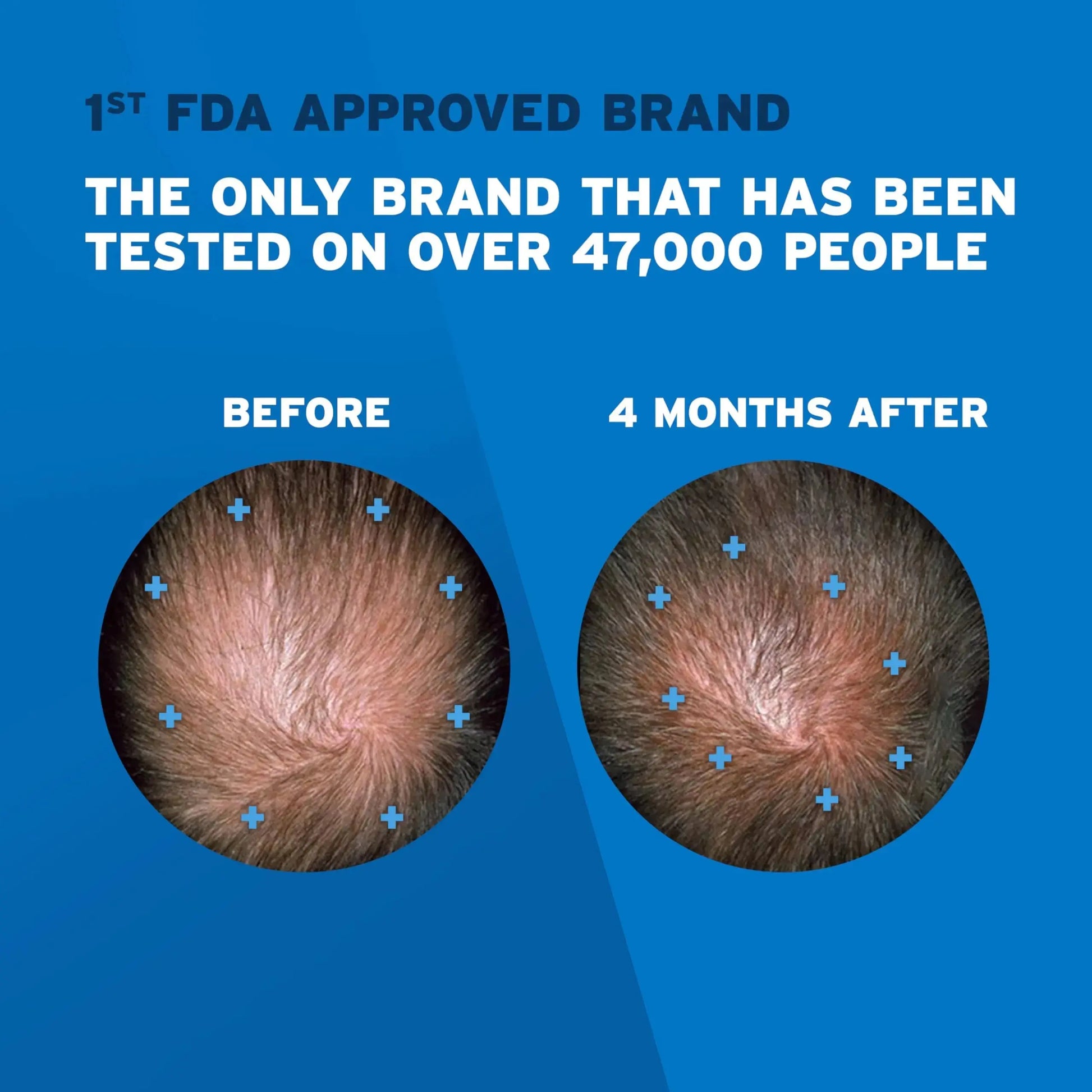 Rogaine Extra Strength Minoxidil Solution