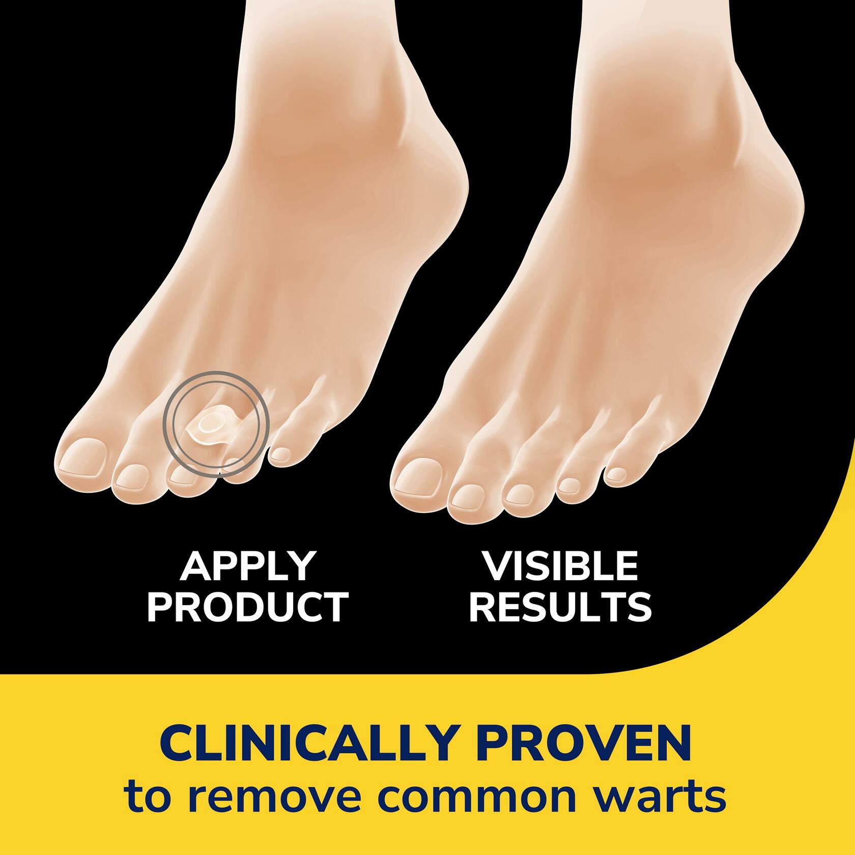 Dr. Scholl’s Clear Away Wart Remover Hydrogel Bandages 9 Count Fingers Toes